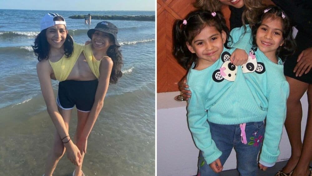 Jóvenes siamesas comparten pelvis y de su vida privada en TikTok siamesas