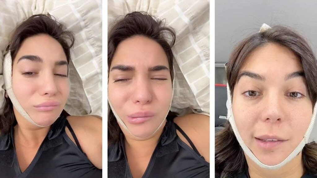 Lipopapada provocó parálisis facial a influencer Luciana Milessi Luciana Milessi