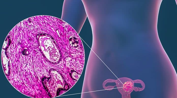 El cáncer de útero aún afronta importantes retos en Latinoamérica, dicen expertos cáncer utero